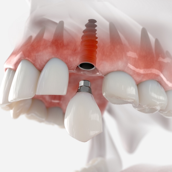 Illustration of a dental crown on a dental implant replacing a missing upper tooth