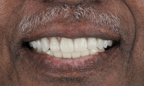 Closeup of November 2025 smile after Long Island Smile Makeover
