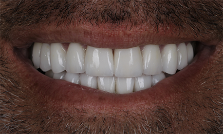 Closeup of september 2025 smile after Long Island Smile Makeover