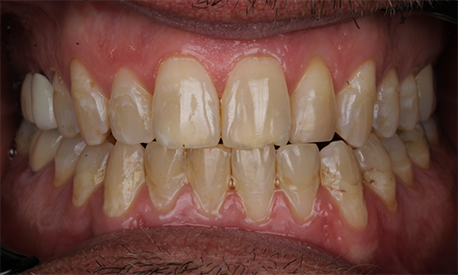 Closeup of september 2025 smile before Long Island Smile Makeover