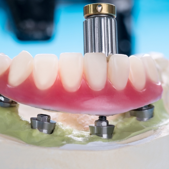 Model of a denture supported by dental implants