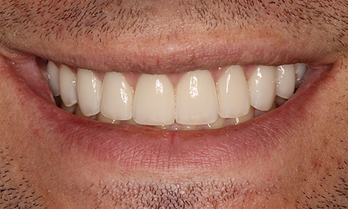 Close-up of teeth lengthened with the help of smile makeover
