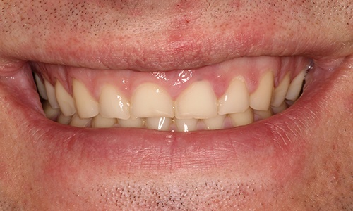Close-up of very short, square teeth