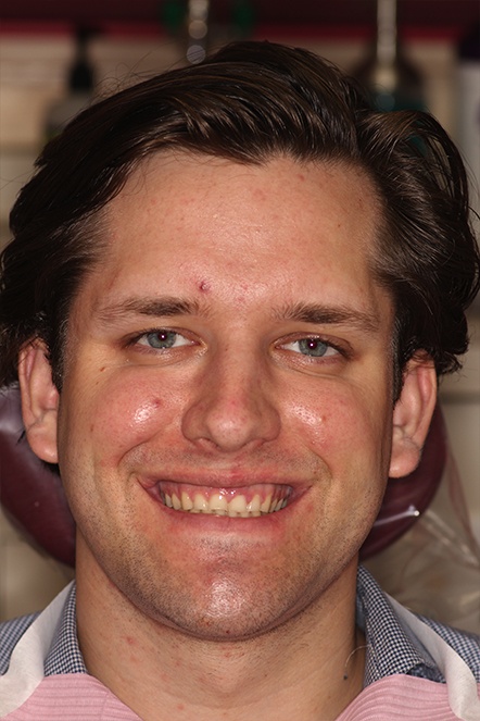 Dental patient Reid showing smile with squared yellow teeth