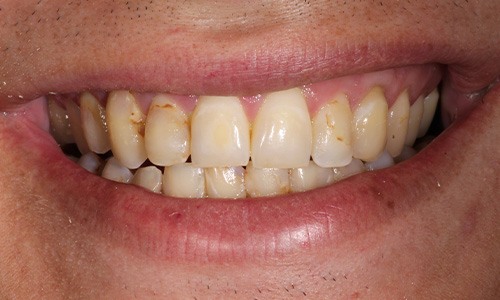 Close-up of multiple yellowed teeth