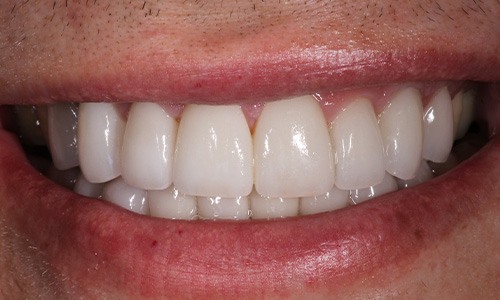 Close-up of teeth that look brighter with veneers