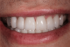 Rich's smile after being transformed by Dr. Mohr and his dental team
