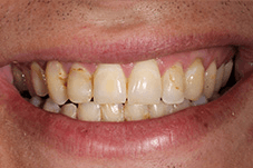 Rich's smile before being treated by Dr. Mohr