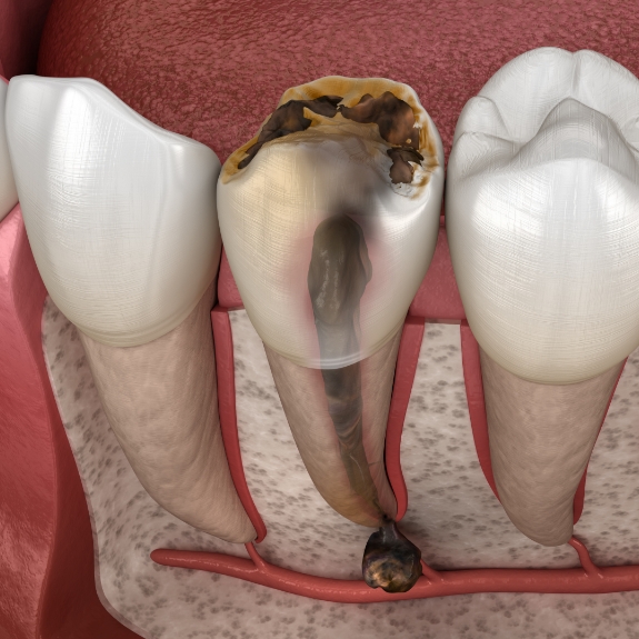 Illustration of a severely decayed tooth with infected gums