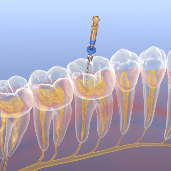 Illustration of a thin dental instrument accessing and treating the center of a tooth