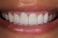 September 2020 gummy smile correction dental patient after treatment closeup