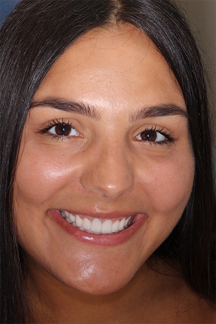 September 2020 gummy smile correction dental patient after treatment