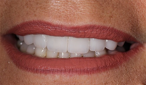 Close-up of smile with repaired and enhanced teeth