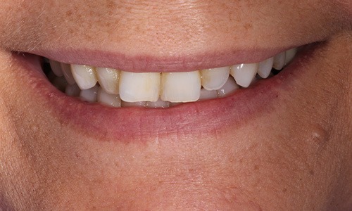 Close-up of smile with damaged teeth