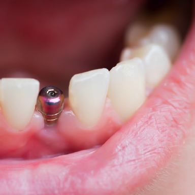 Close-up image of single-tooth dental implant in Massapequa Park