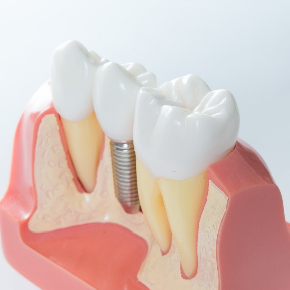 Model of a single tooth dental implant in between two natural teeth