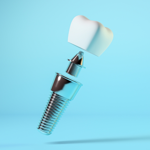 Illustration of a dental implant a crown and a metal abutment connector piece