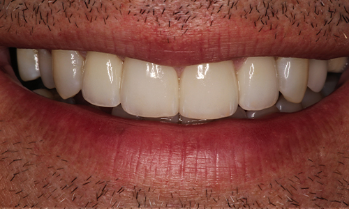 Close-up of smile with veneers used to close gaps