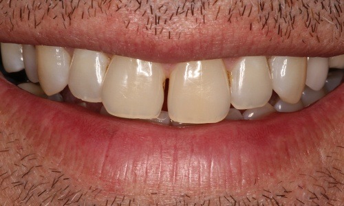 Close-up of smile with gap between upper teeth