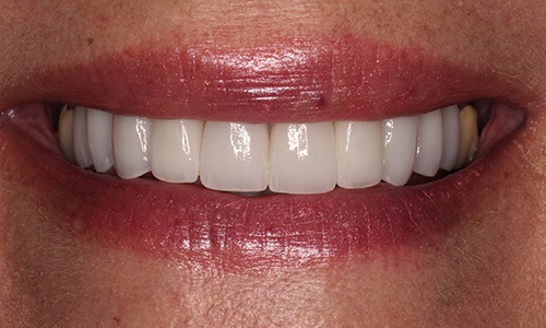 Close-up of April 2020 patient's smile after treatment