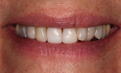 Close-up of April 2020 patient's smile before treatment