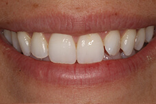 Jessica's smile before veneer placement