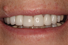 Closeup of Rhonda's smile after treatment