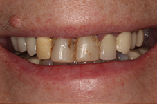 Closeup of Rhonda's smile before treatment