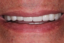 Closeup of Ray after Long Island dental implants