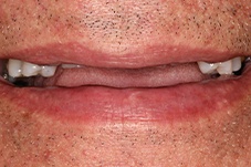 Closeup of Ray before Long Island dental implants