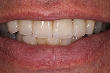 Closeup of Ed after porcelain bridge and veneers