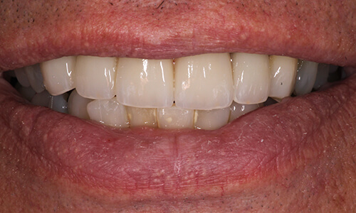 Close-up of smile after tooth has been replaced