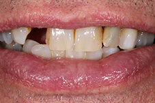 Closeup of Ed before Long Island porcelain bridge and veneers