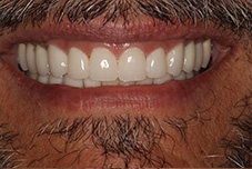 August 2015 closeup full mouth reconstruction patient after