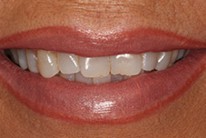 Closeup of smile before treatment