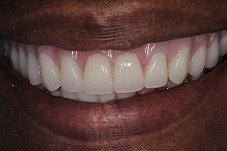 After picture of patient's teeth in August 2022
