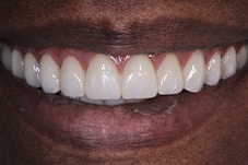Closeup of Mary Ann before Long Island implant dentures 