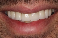 August 2019 patient after treatment closeup