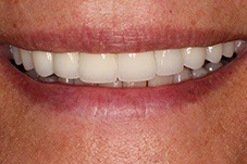 August 2020 front of smile after makeover