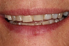 August 2020 front of smile before makeover