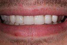 Closeup of Dom after veneers