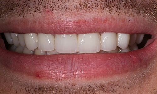 Close-up of smile subtly improved with veneers