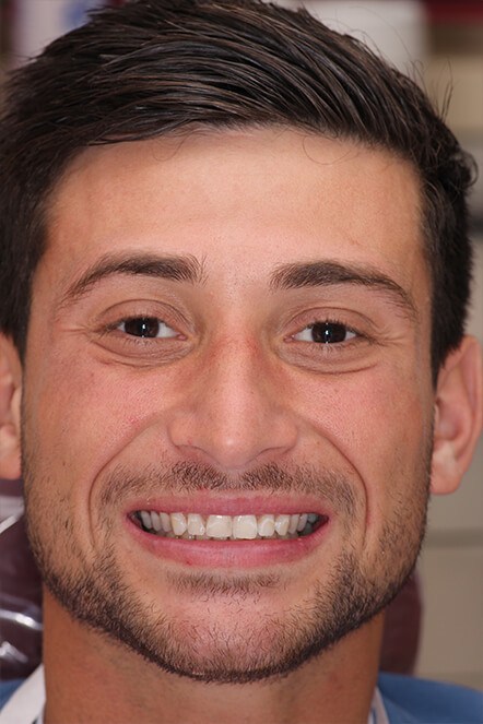 Headshot of August 2021 patient showing teeth before treatment