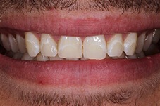 Closeup of Dom before Long Island veneers treatment