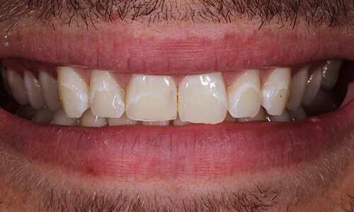 Close-up of smile with slight discoloration