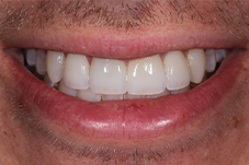 Closeup of Jerry after smile makeover