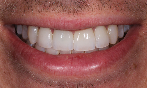 Close-up of a smile that now looks much whiter