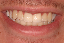 Closeup of Jerry before Long Island veneers dental treatment
