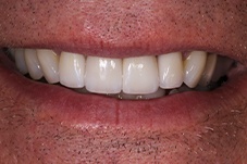 Closeup of Jack after porcelain crowns and veneers