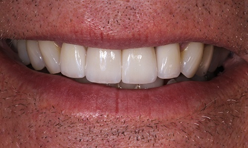 Close-up of dental crowns used to repair chipped teeth